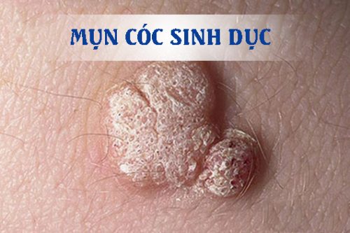 Mụn cóc sinh dục giai đoạn đầu
